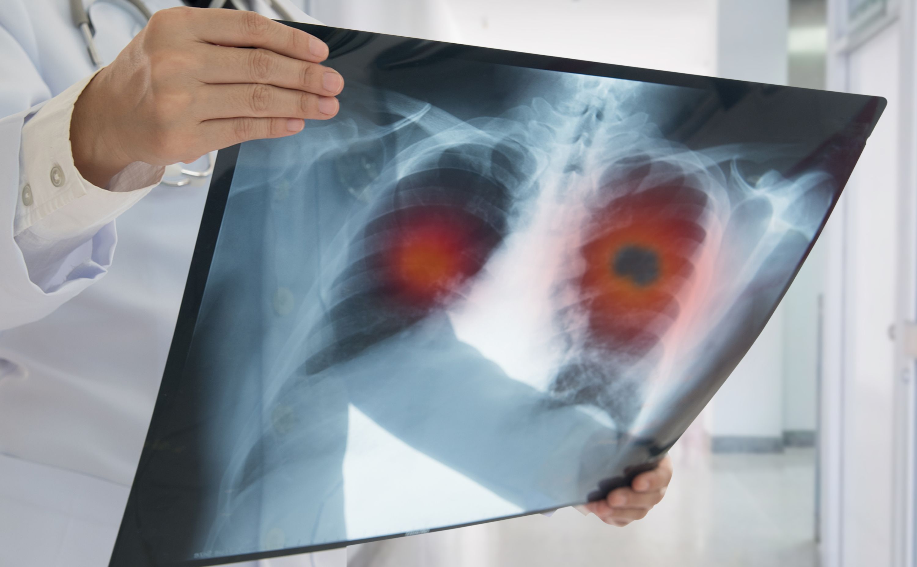 rak płuca nowotwory immunoterapia diagnostyka molekularna ozymertynib lung cancer units terapie celowane onkologia zdrowie nowoczesne leczenie płynna biopsja refundacja leków rak nie drobnokomórkowy rak drobnokomórkowy system ochrony zdrowia